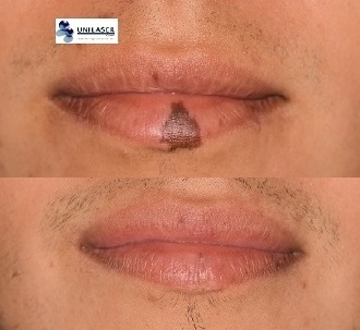macula melanotica labial