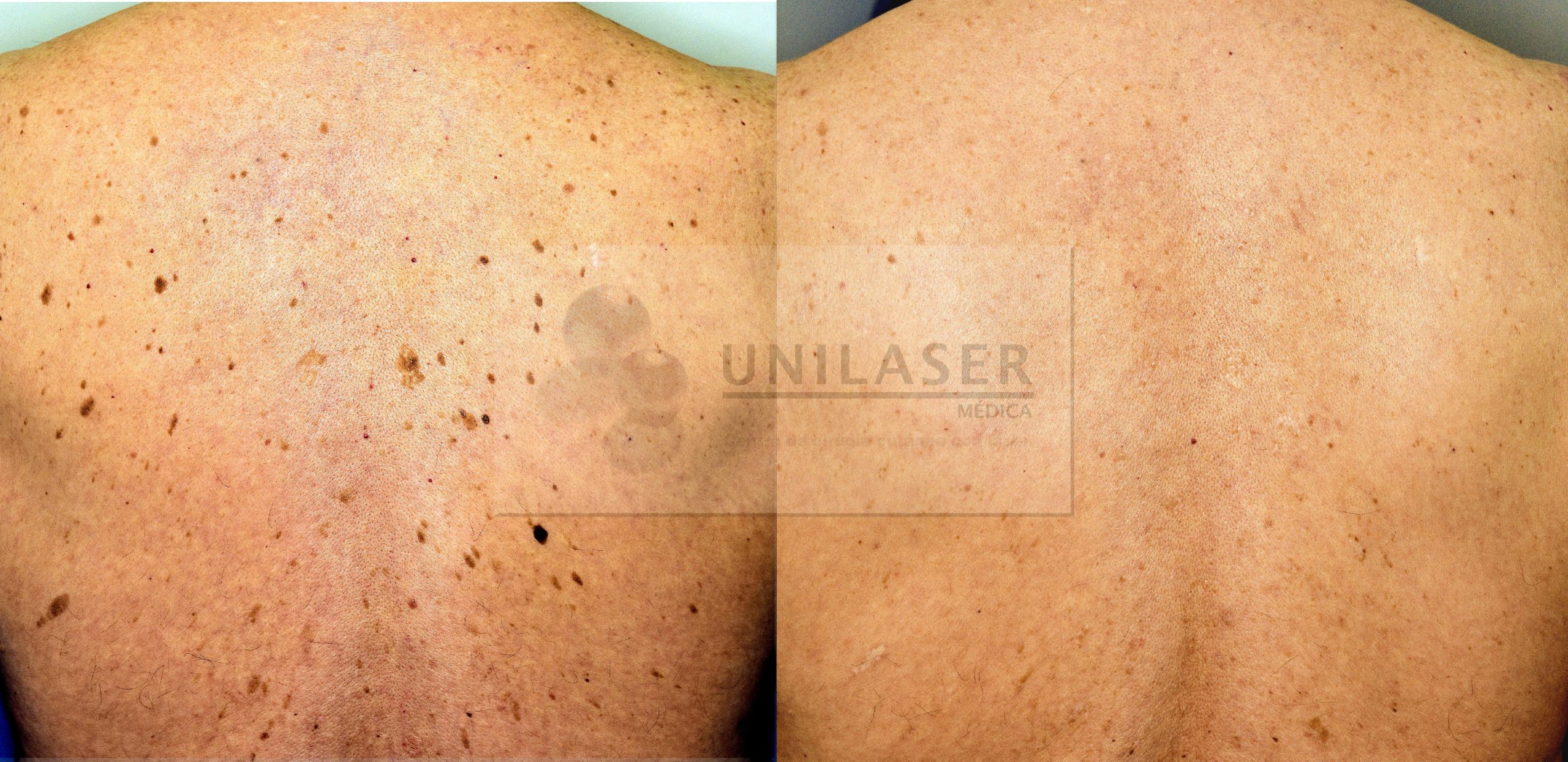 Resultado del tratamiento láser de queratosis seborreícas láser para queratosis seborreicas