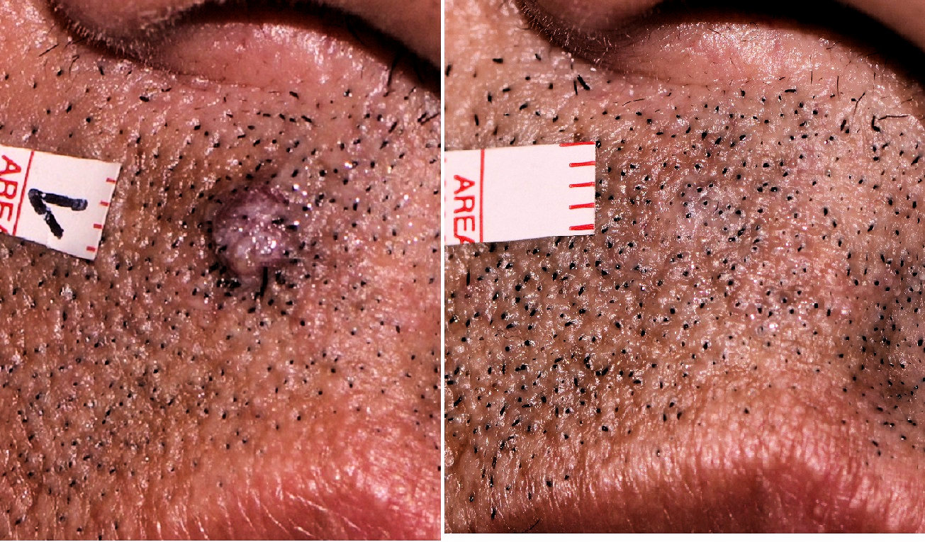 Hemangioma tratado con láser
