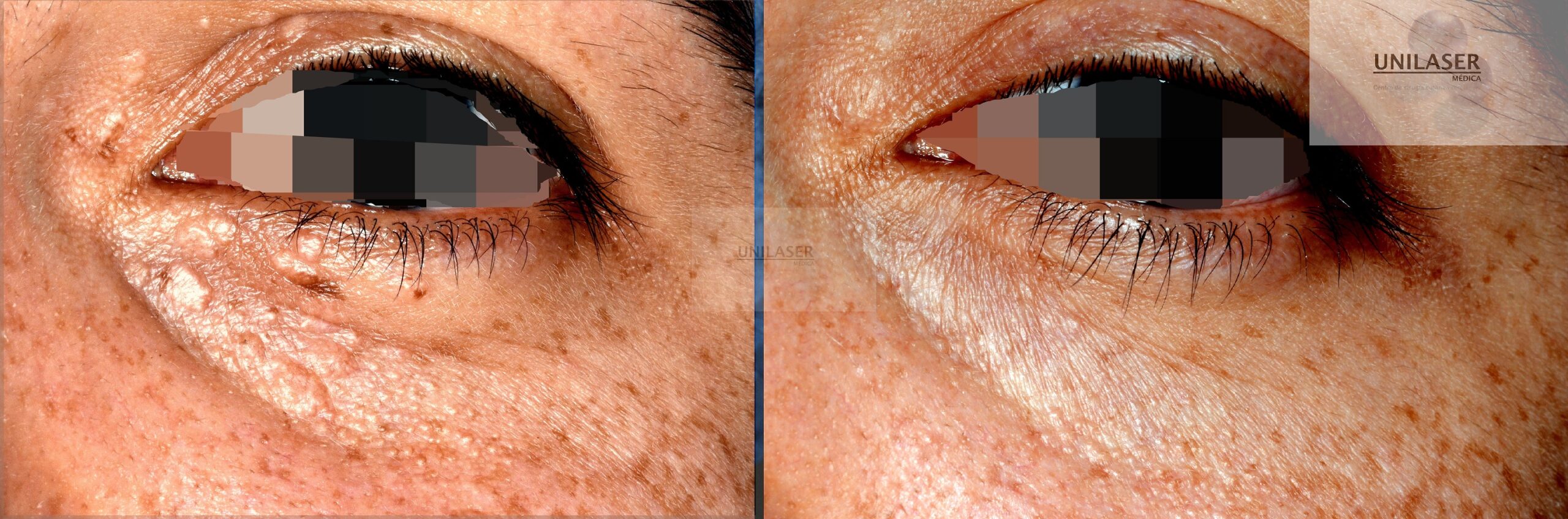 2 años tratamiento siringomas Siringomas palpebrales tratados con láser