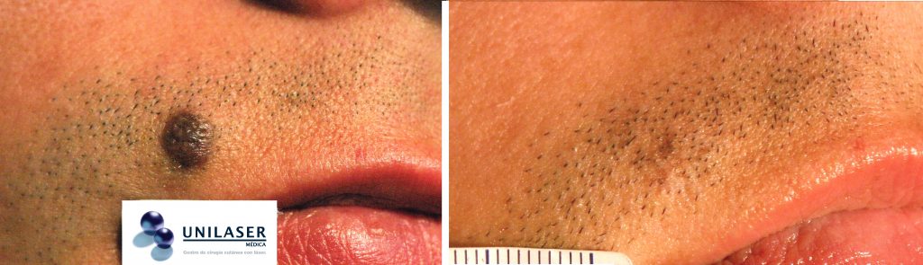 Nevus de Meischer del labio superior