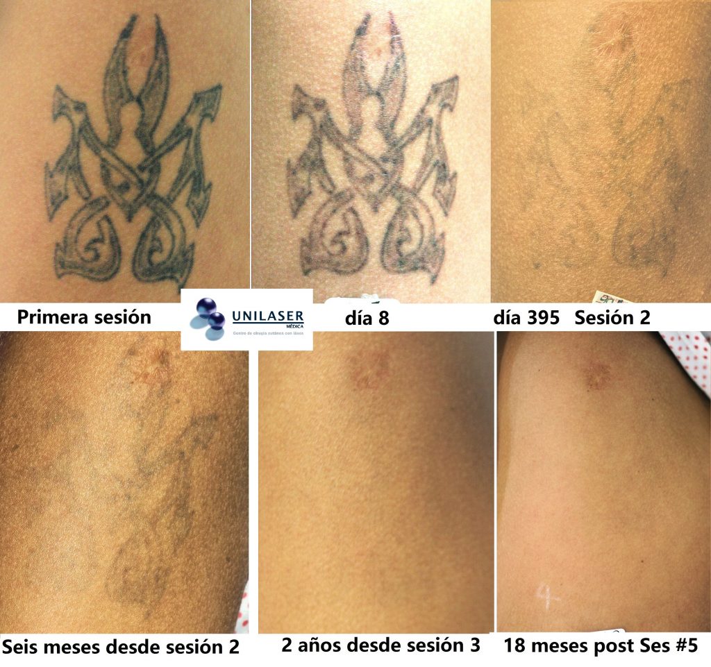 El efecto a los 8 días no muestra aclaración. Posterior a un año de la primera sesión fue muy notorio el cambio. Un control a los 6 meses después de la segunda sesión no muestra cambios significativos. Dos años después de una tercera sesión muestra desaparición de la tinta del tatuaje casi completa. 18 meses después de la sesión 5 no hay tinta visible. Tiempo total un poca más de 5 años en desaparecer la tinta posterior a 5 sesiones.