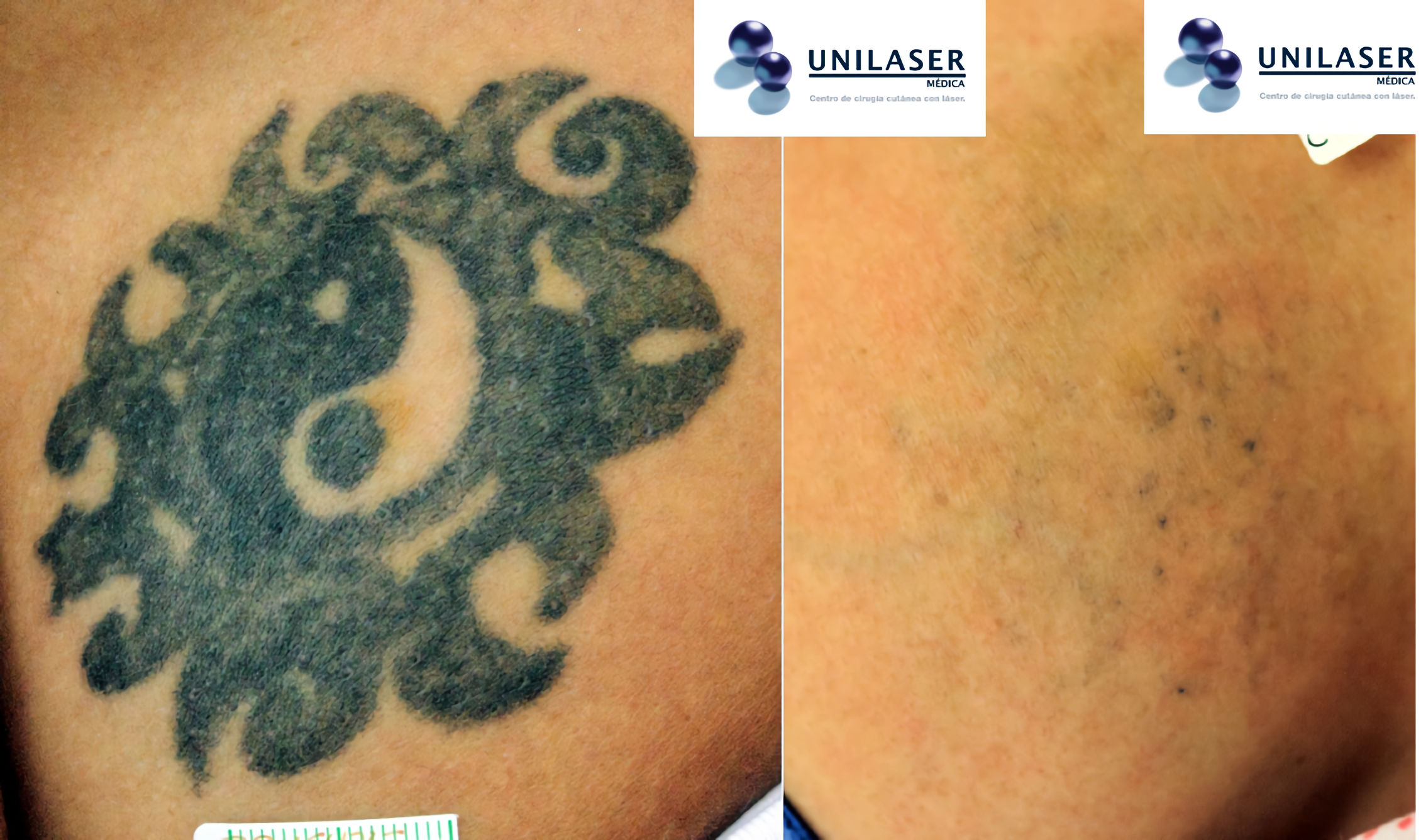Desaparición bastante importante de tatuaje no profesional antiguo. Persisten zonas puntuales