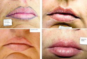 Eliminación tatuaje cosmético labios
