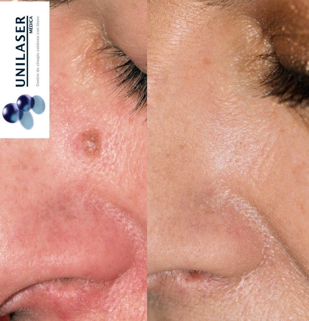 Cicatriz estética posterior al láser