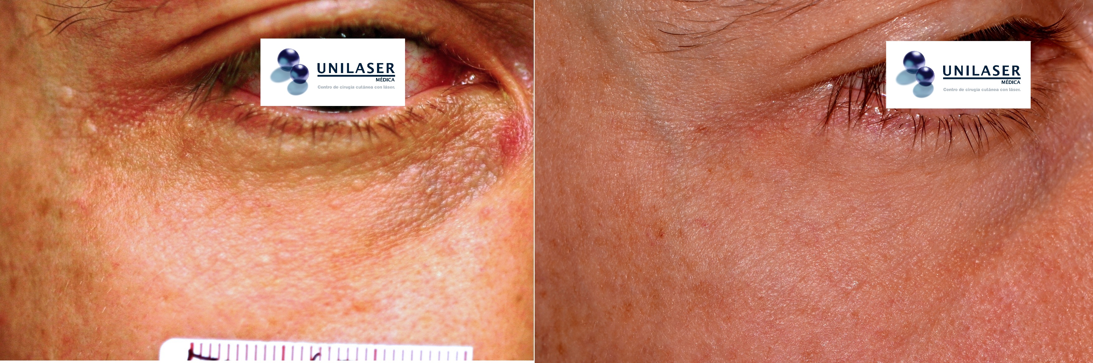 Resección de siringomas asistida con láser tratamiento de siringomas con láser