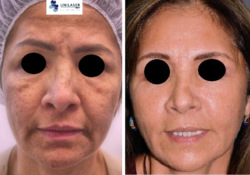 láser , rellenos y botox