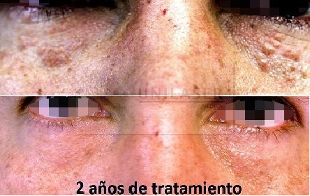 Siringomas en los párpados tratados con láser tratamiento láser de siringomas en los párpados