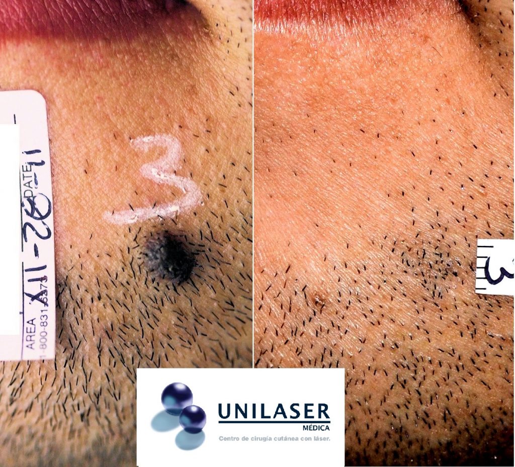 Afeitado láser de lunar en la barbilla evitando zonas alopecia cicatricial