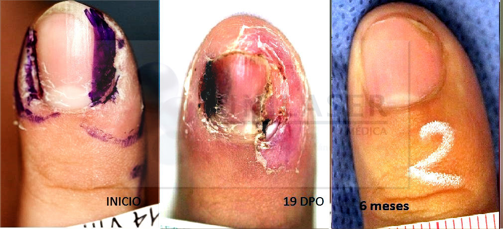 Seguimiento posterior a vaporización de verruga periungueal extensa