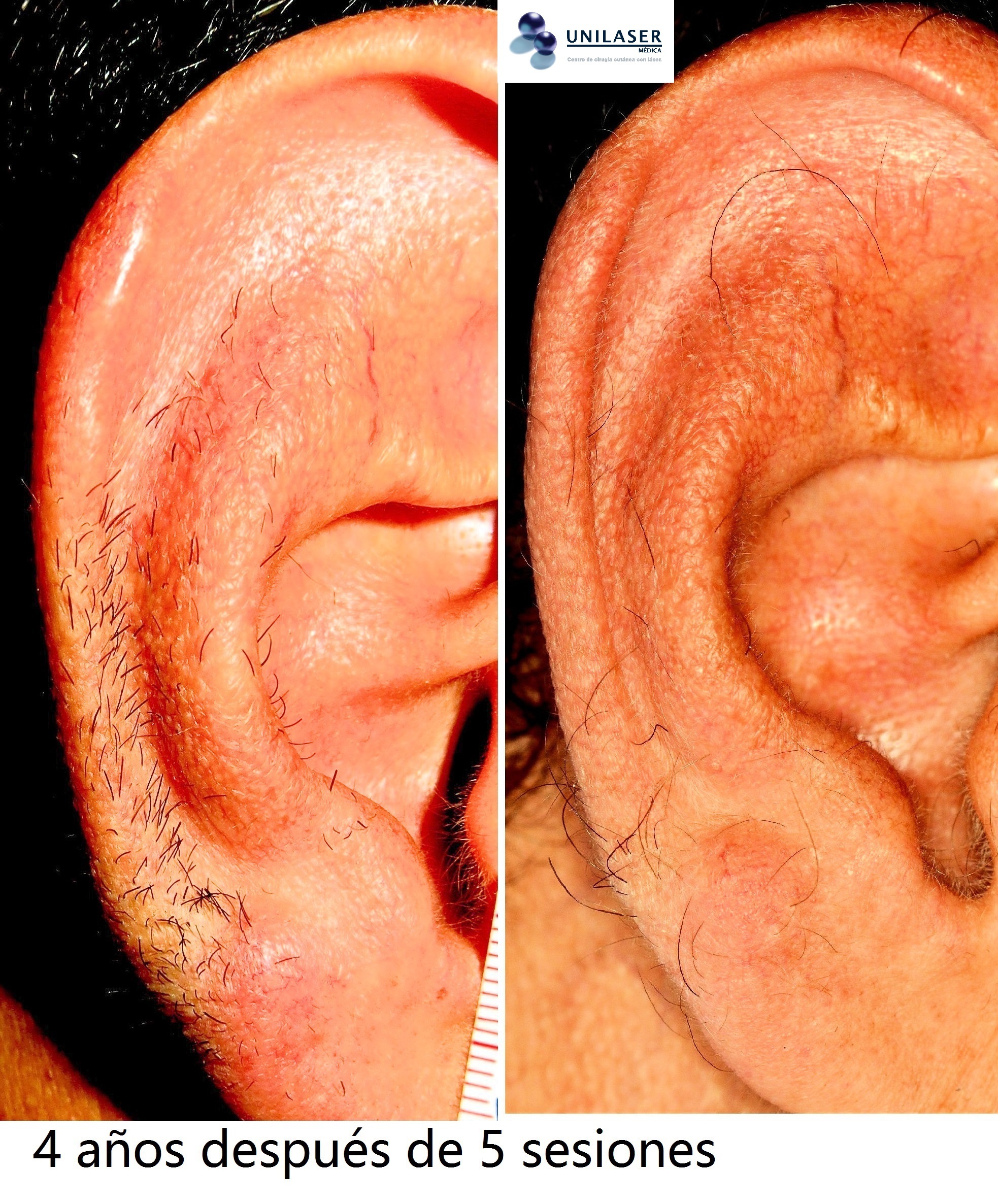 Depilación pabellones auriculares