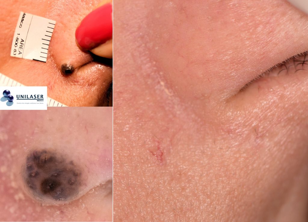El ala nasal solo admite la vaporización de nevus superficiales