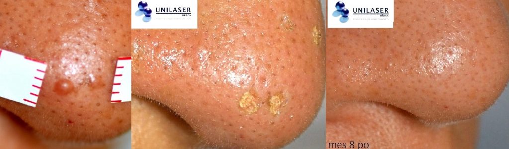 La proximidad de las lesiones exige una mayor delimitación del instrumento utilizado. El procedimiento preservó la curvatura nasal y al control del octavo mes, documentó lano presencia de lesión