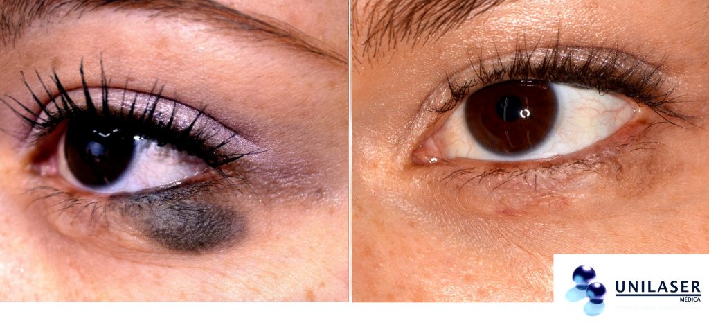 Nevus gigante del párpado inferior tratado con láser