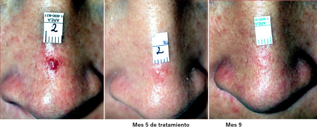 Spider nevus