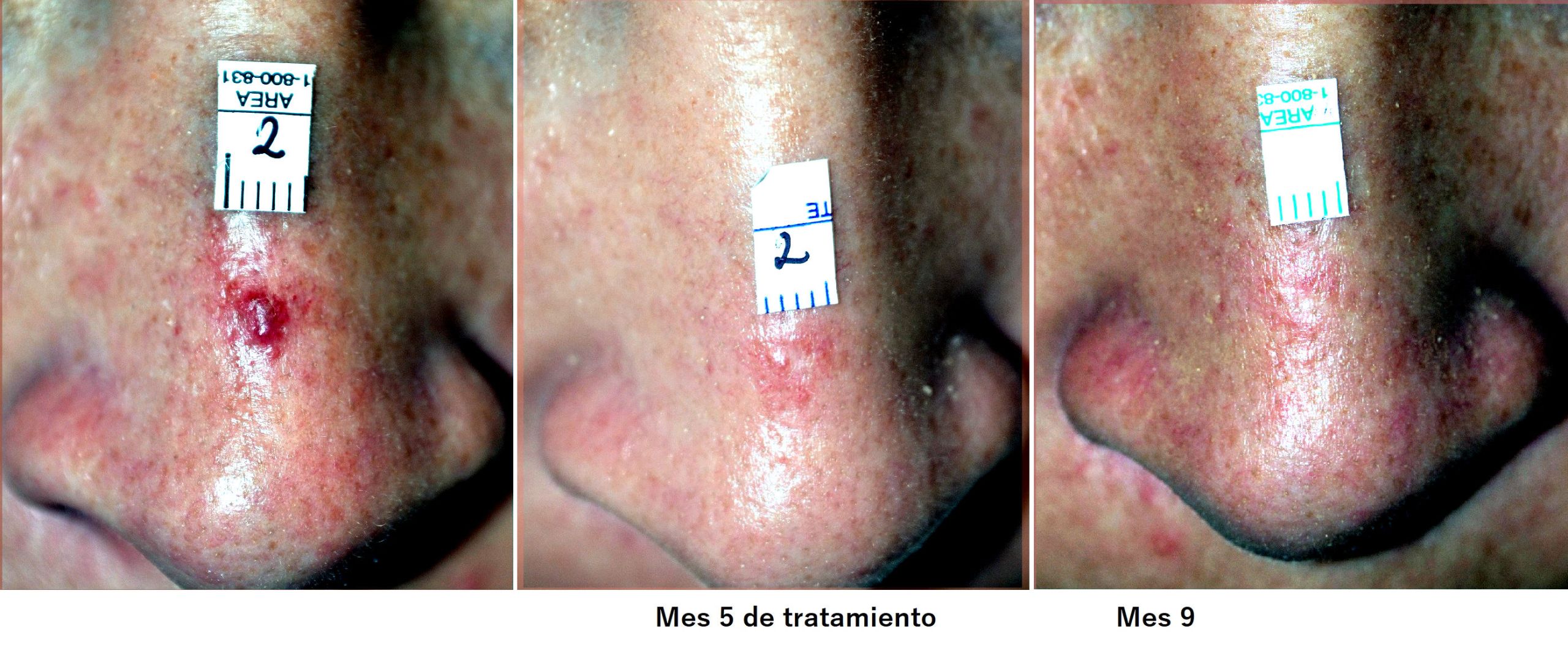 Spider nevus