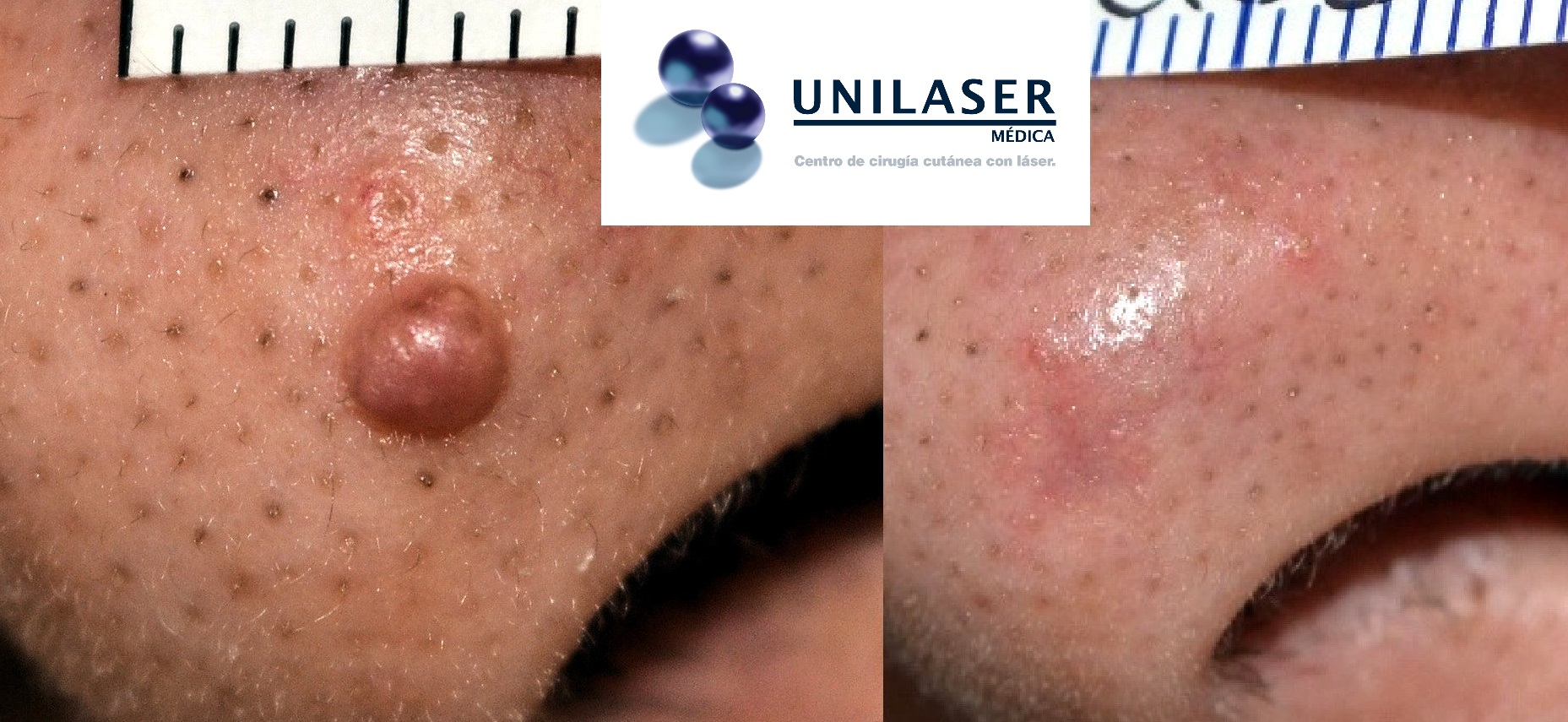 Completa y rápida nivelación de la piel tratada con láser para una lesión en la punta nasal Completa y rápida nivelación de la piel tratada con láser para una lesión en la punta nasal
