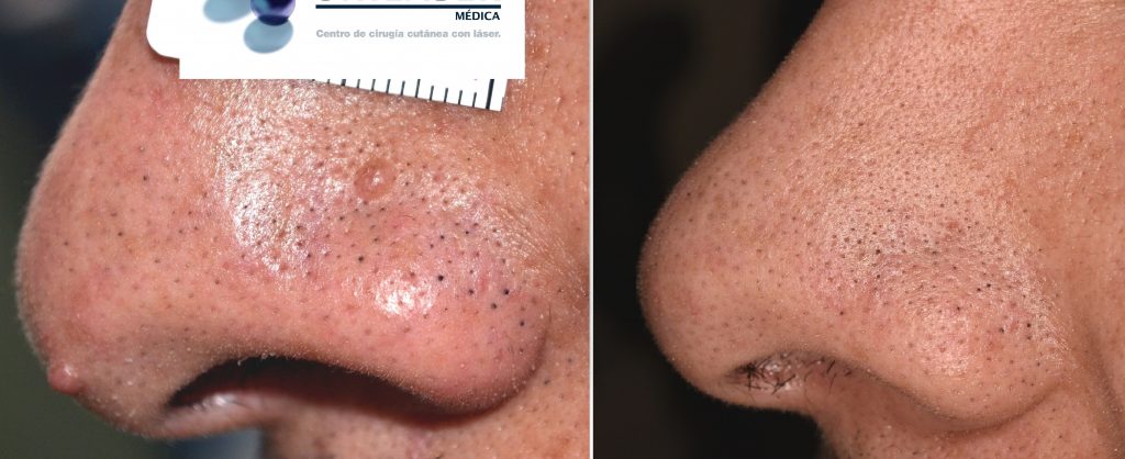 Resultado a 5 años de la vaporización de pápulas fibrosas del ala nasal