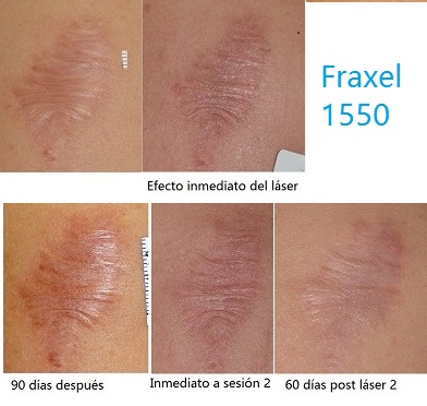 laser fraxel cicatrices