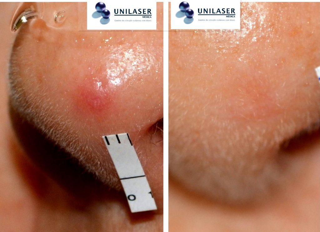 Presentación con alto componente angiomatoso de una pápula fibrosa del ala nasal.