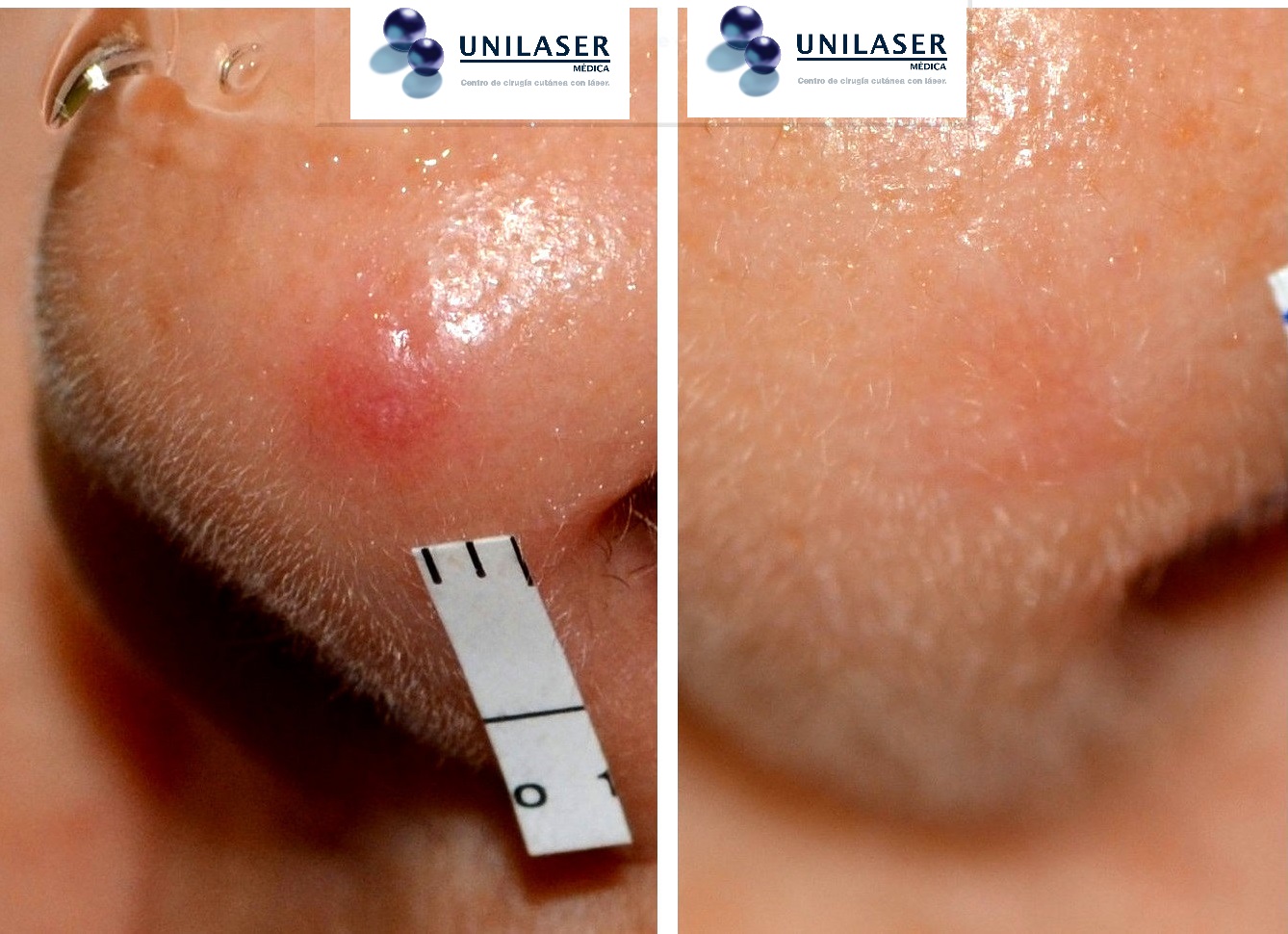 Presentación con alto componente angiomatoso de una pápula fibrosa del ala nasal. Presentación con alto componente angiomatoso de una pápula fibrosa del ala nasal.
