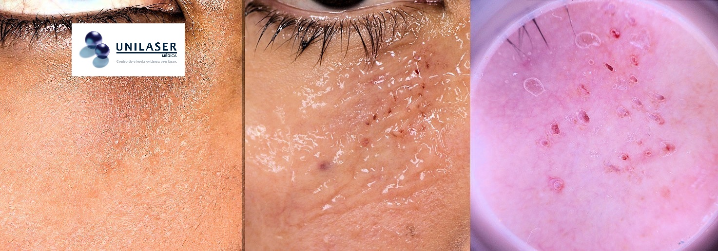 láser para siringomas microscópicos acción del láser en microsiringomas