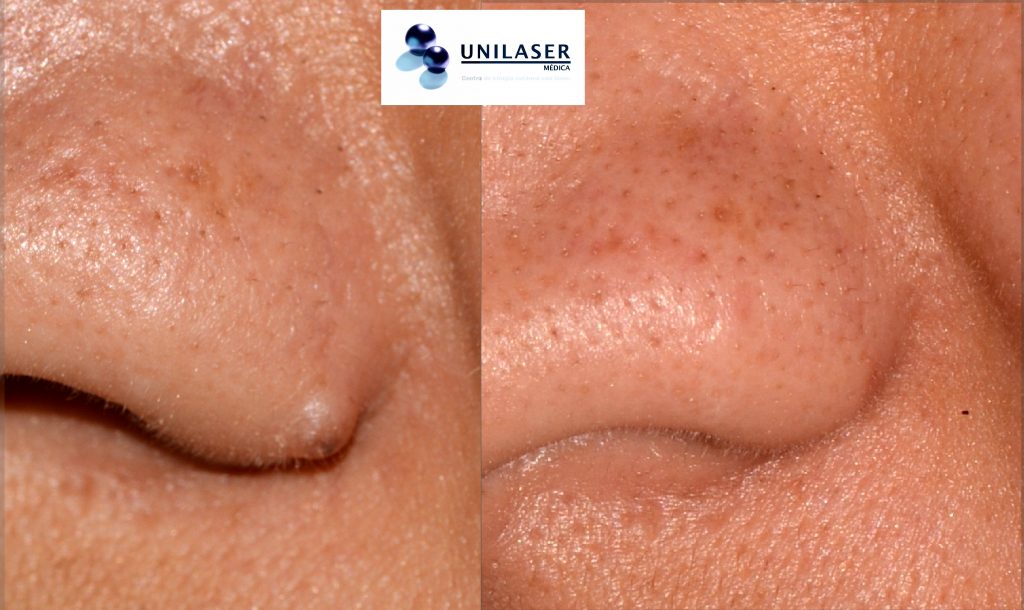 Resultado estético aceptable en la resección con láser de un nevus del ala nasal