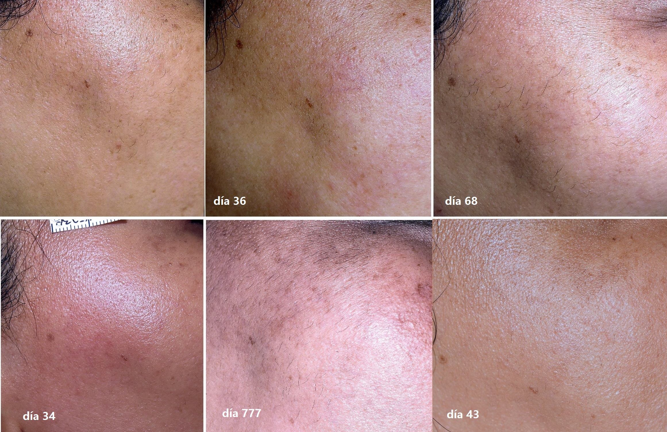 depilación láser facial