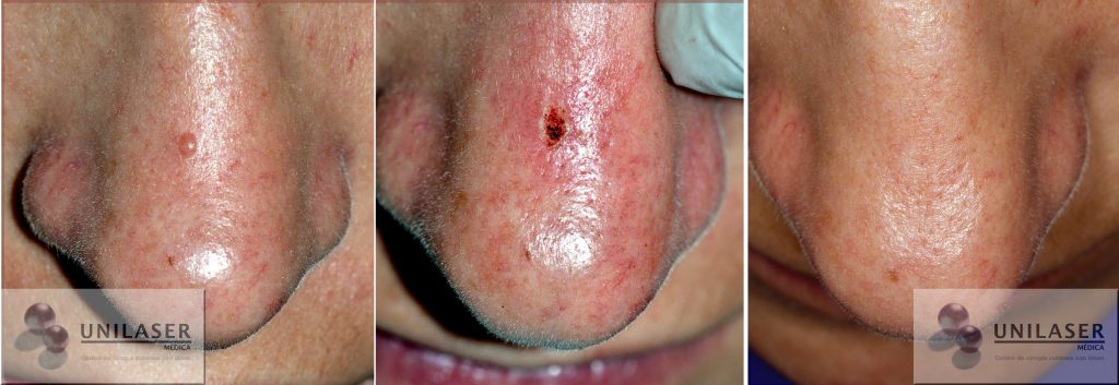 Extirpación siringomas con láser