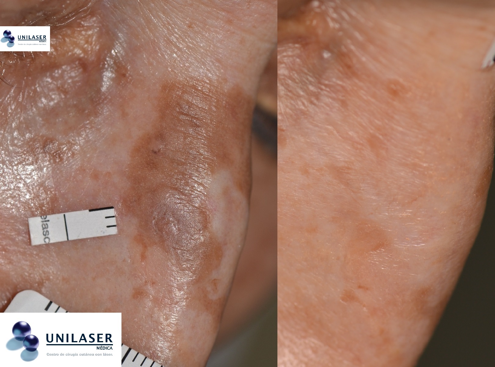 Los léntigos son más que manchas