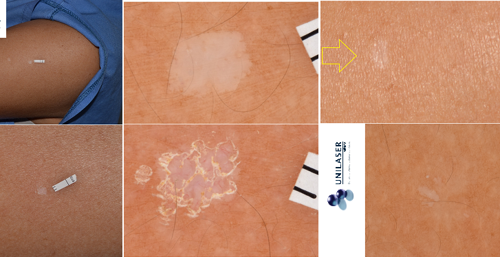 Tratamiento de la hipomelanosis gutata con láser