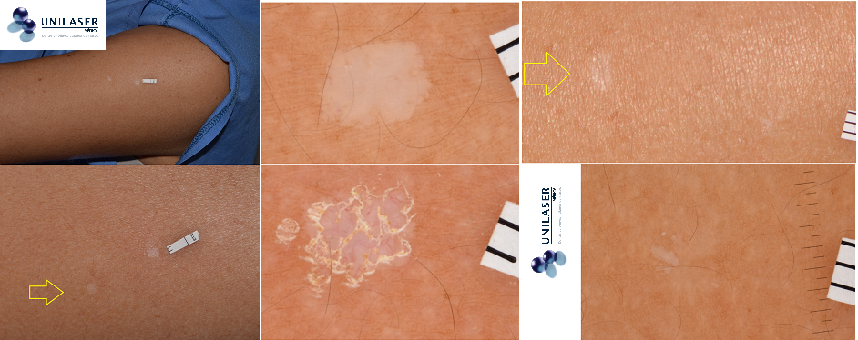 Tratamiento de la hipomelanosis Guttata con láser