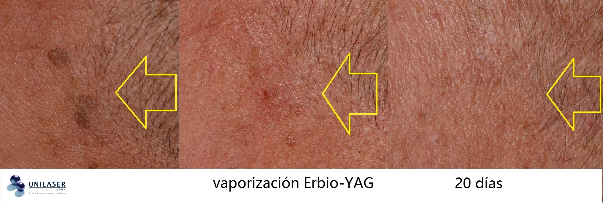 Efecto del láser Efecto del láser