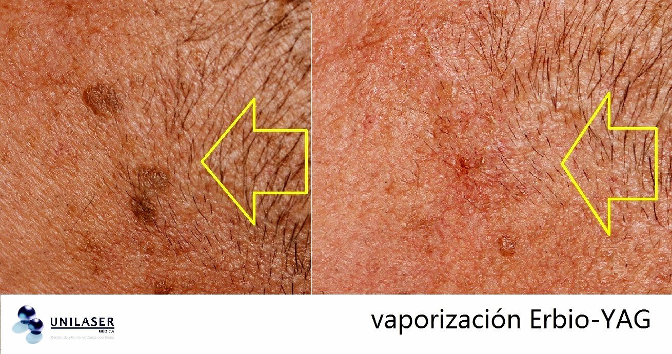 Efecto del láser