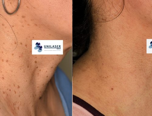 El láser para las verrugas en el cuello