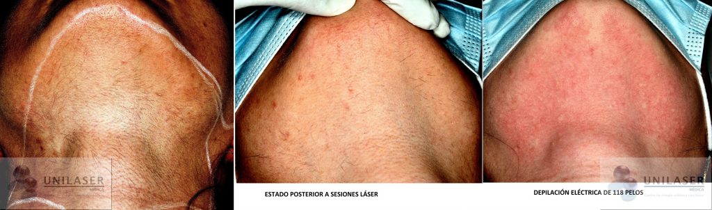 Pelo persistente posterior al láser
