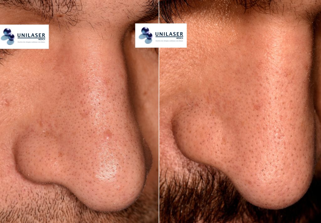 Cicatriz estética pósterior a remoción de pápula fibrosa del ala nasal . 10 meses posoperatorio