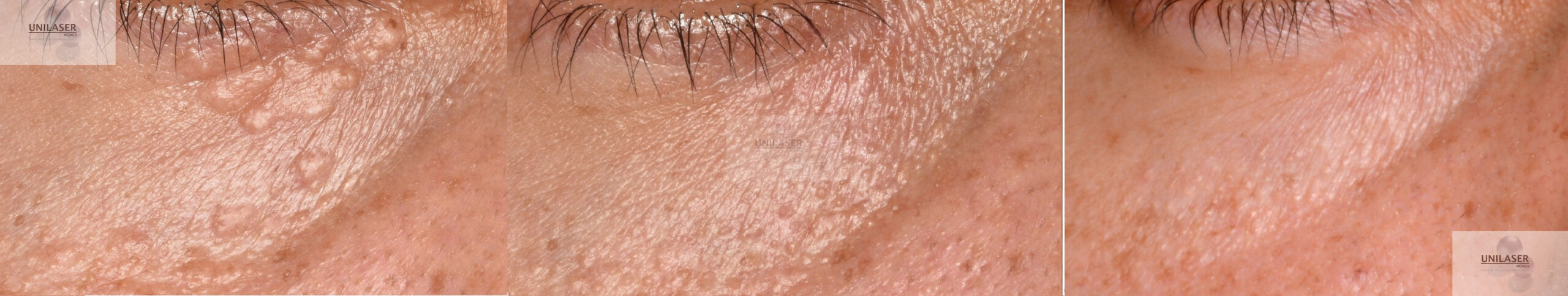 Resultado a 7 meses y 3 años despues tratamiento siringomas Resultado tratamiento dr rios siringomas