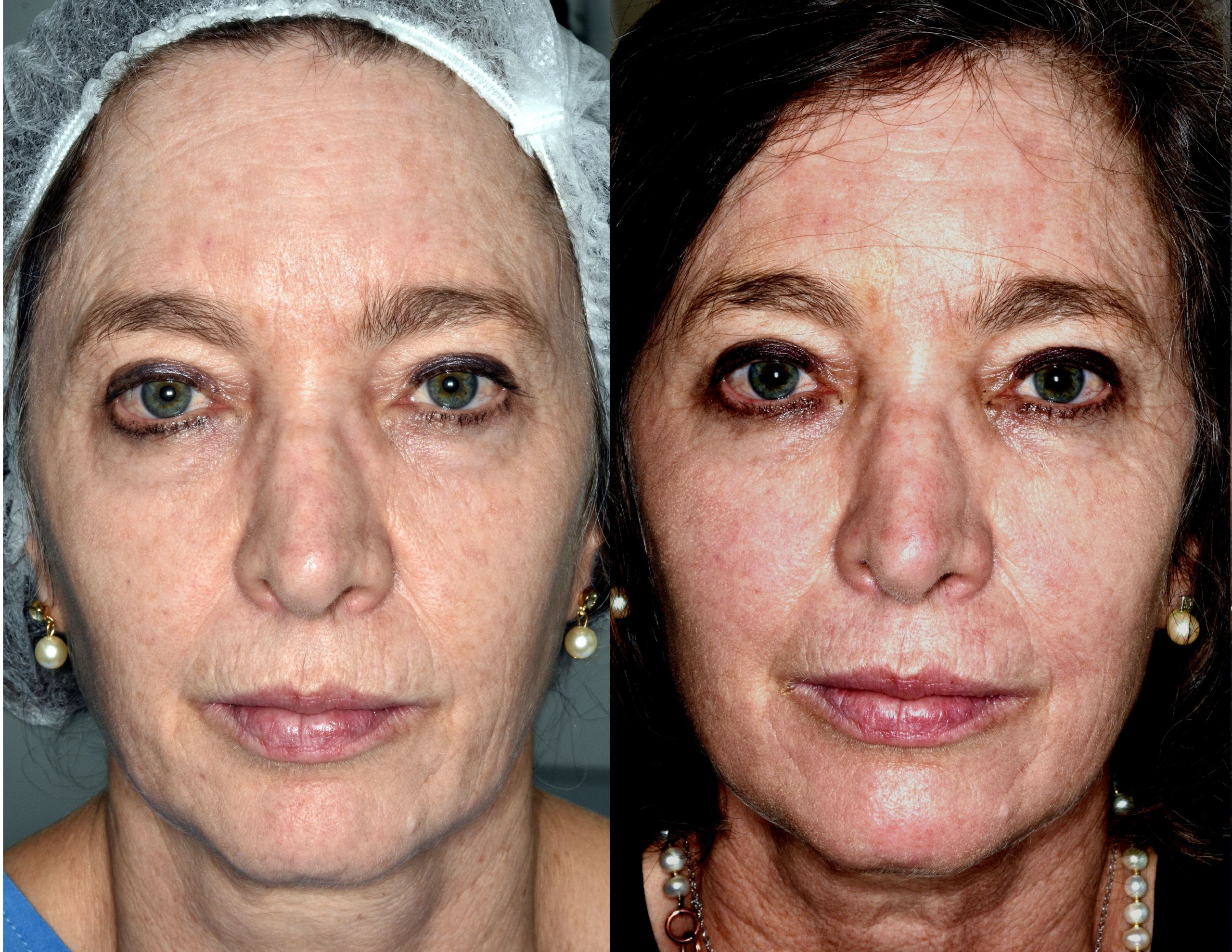 Efecto del Youlaser más Kiara en la cara