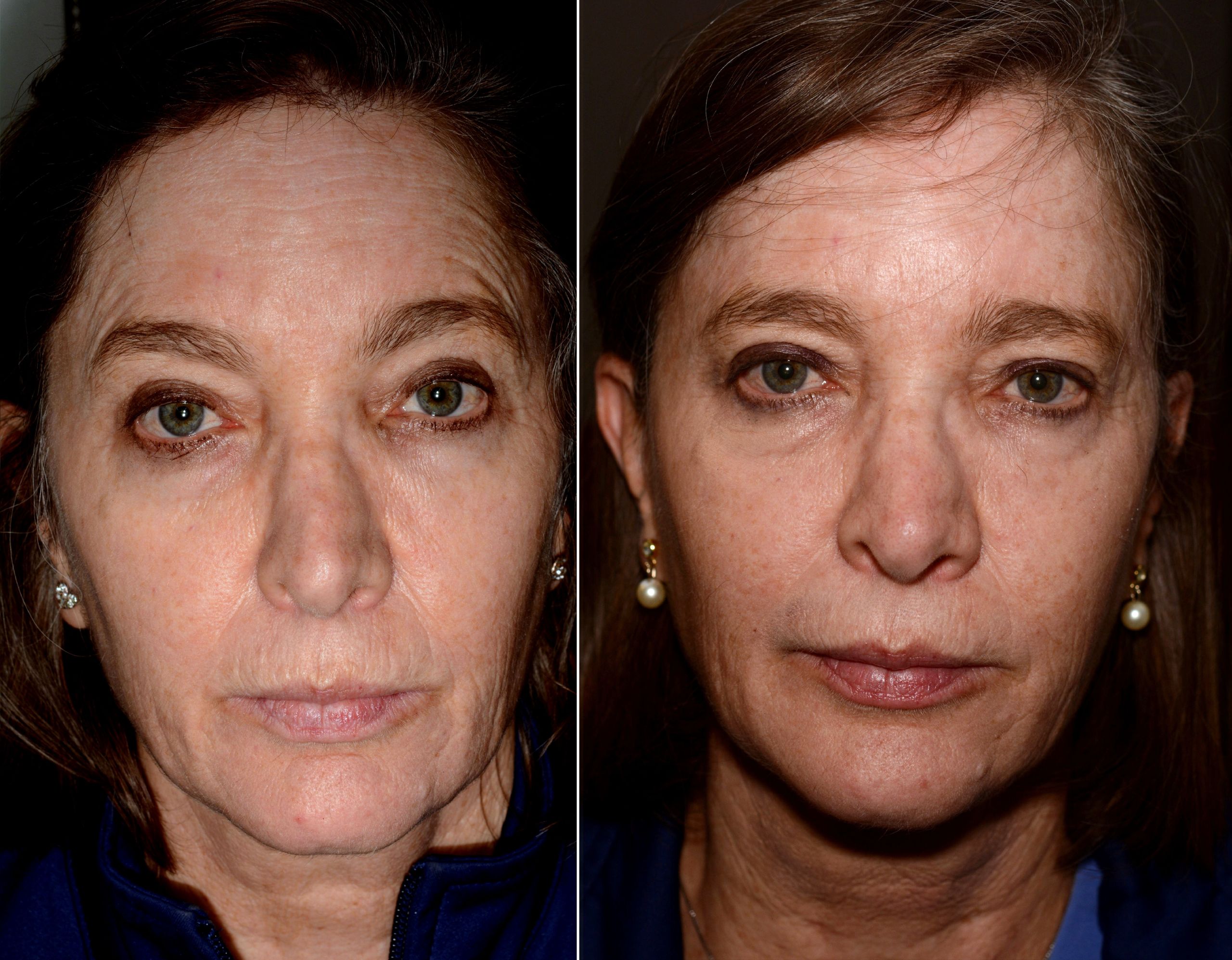 Efecto del botox