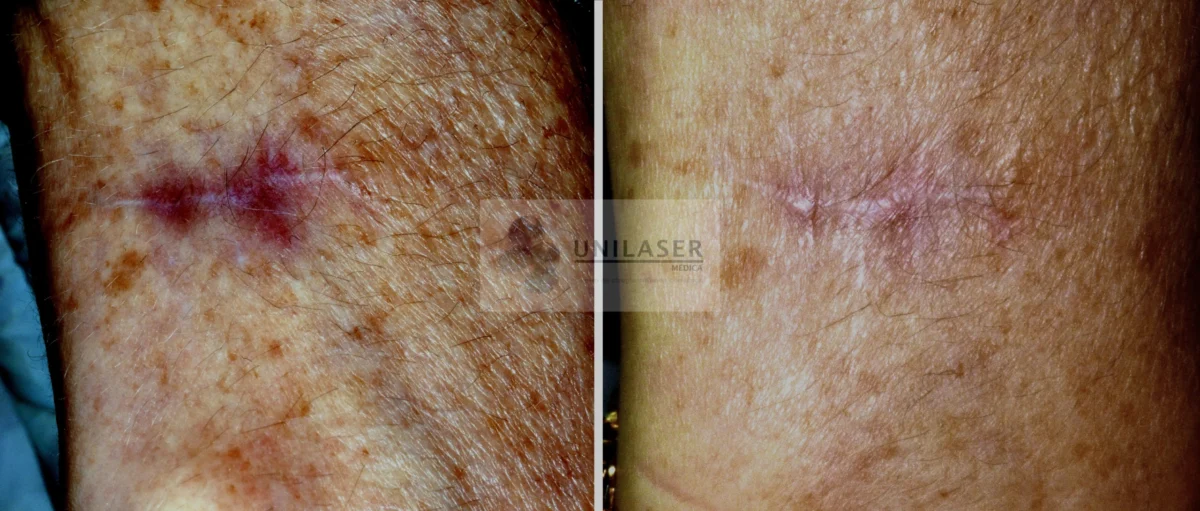 Cicatriz inmadura de evolución prolongada. La comparación muestra disminución progresiva del color vascular y una cicatriz más integrada con la piel vecina.