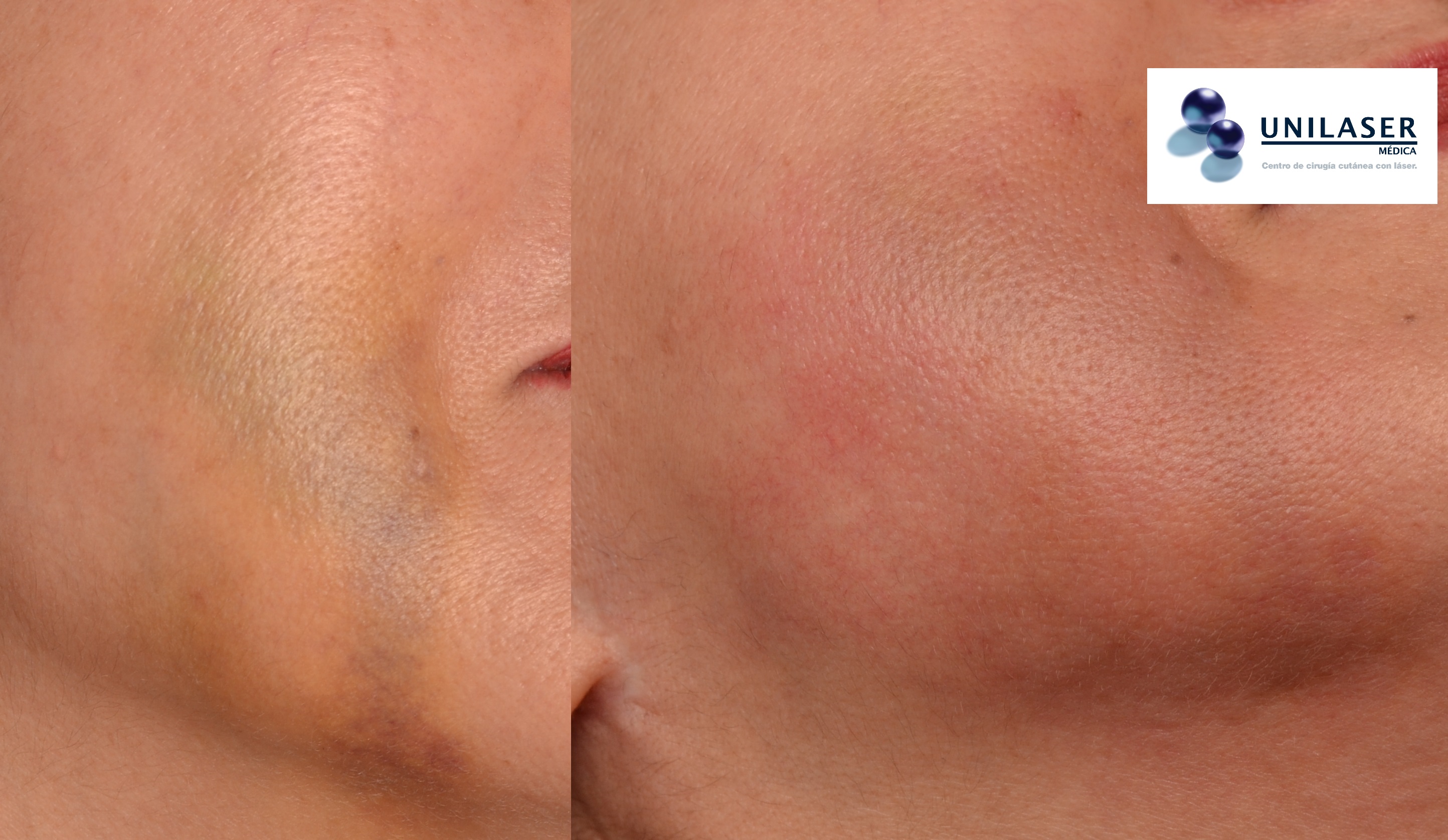 aclaración inmediata de hematoma con láser Fraxel