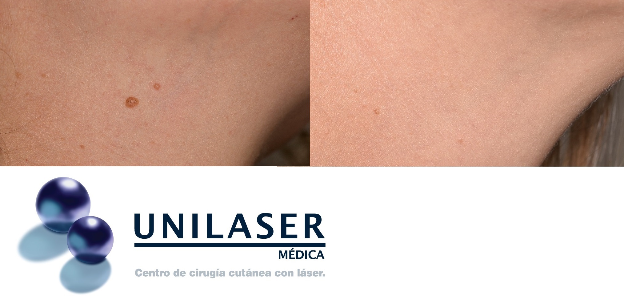 quitar lunares bogota
