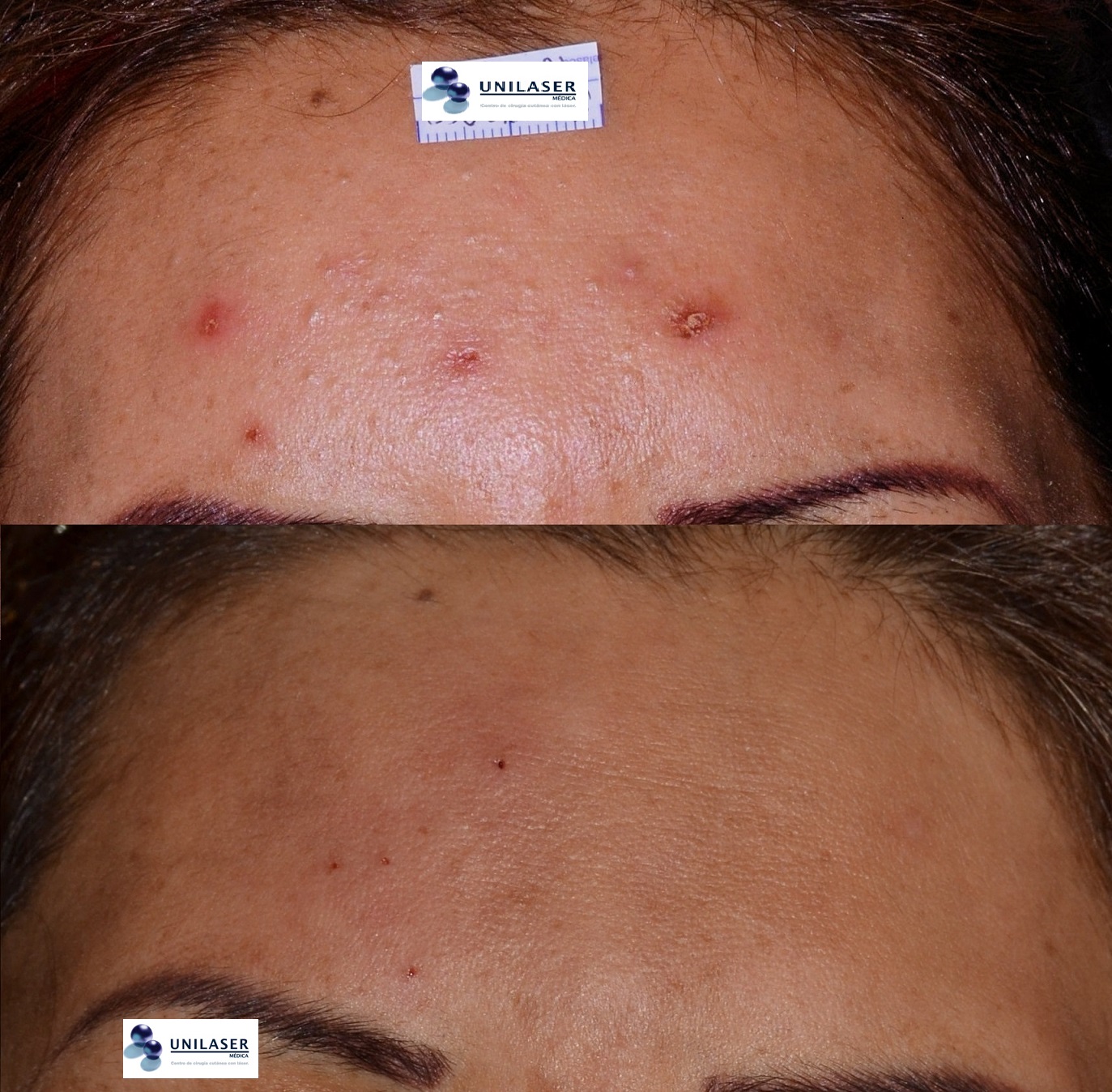 Las escoriaciones son mayores cuando los comedones son de difícil extracción manual como se aprecia en la fotografía superior. La comedolisis asistida con láser logra la desaparición completa y libre de lesión a la piel vecina