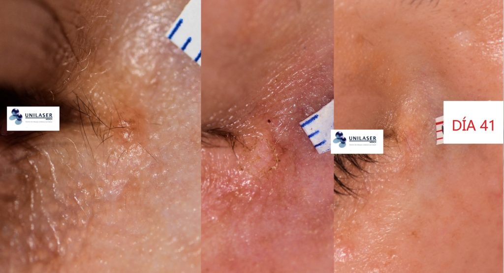Nevus intradérmico por delante del canto interno del ojo derecho vaporizado con láser Erbio-YAG Una pequeña zona despigmentada es apenas notoria en el segundo mes