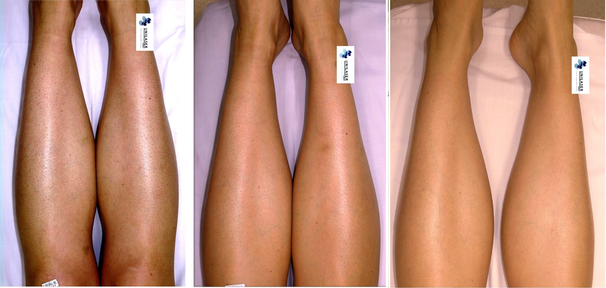 Piernas · disminución progresiva de densidad y miniaturización del pelo residual.