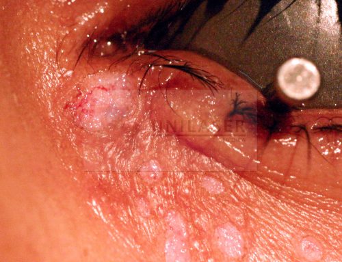 He laser for remove the syringomas of the eyelids