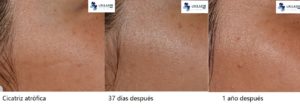 Eliminación de cicatriz atrófica con láser Fraxel 