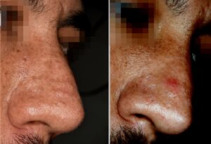 Cicatrices papular del acné en el dorso nasal