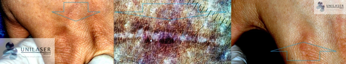Cicatrices papulares del dorso nasal. Control 6 meses después de completar 6 meses de tratamiento.